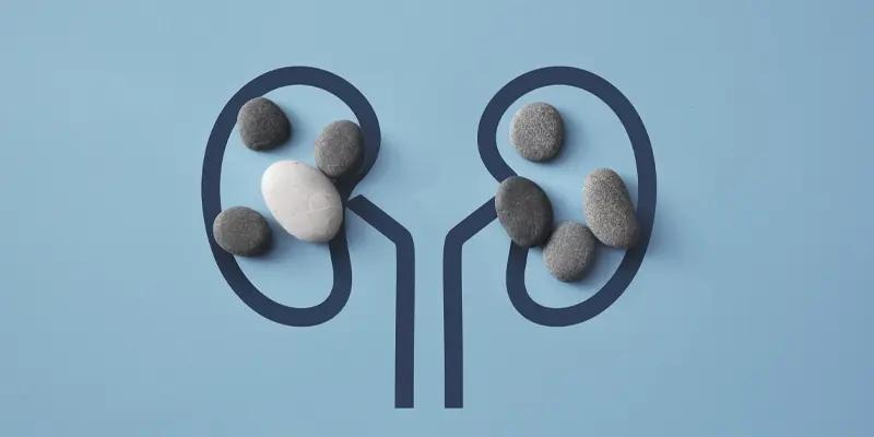 Kidney Stones treated with Laparoscopy