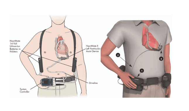 LVAD-treatment.png